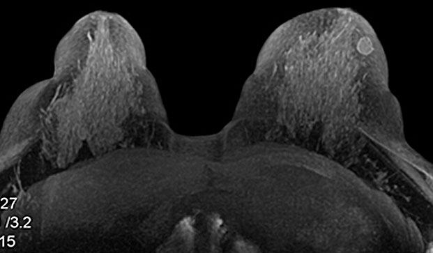 Breast MRI