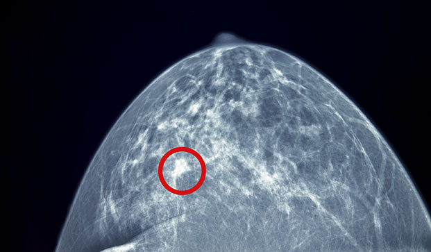 Diagnostic Mammogram