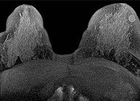 Breast MRI