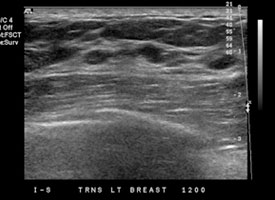 Breast Ultrasound