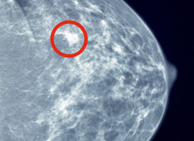 Diagnostic Mammogram