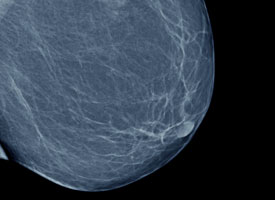 Screening Mammogram